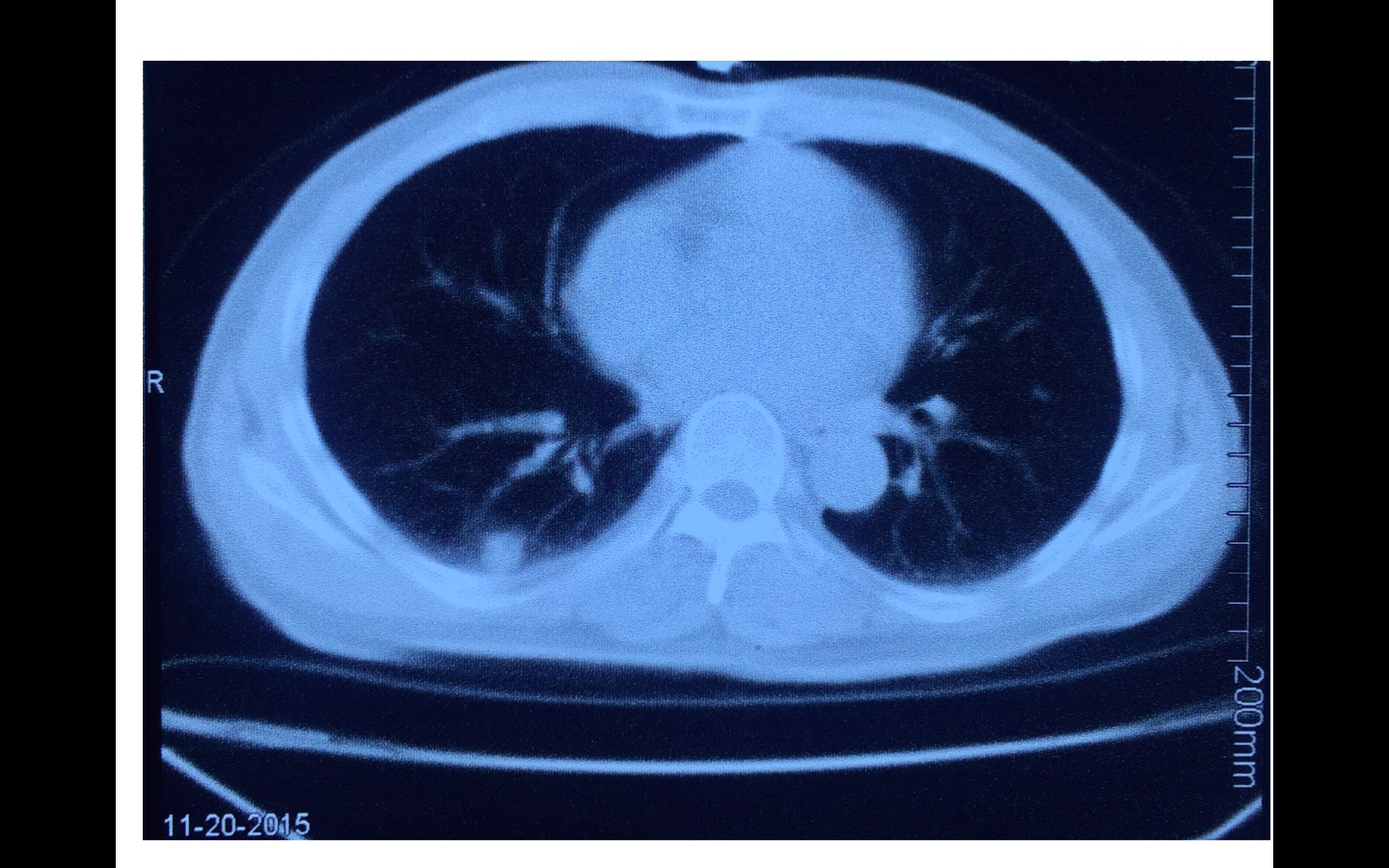 肺小结节-感染 vs 肿瘤-1.jpg