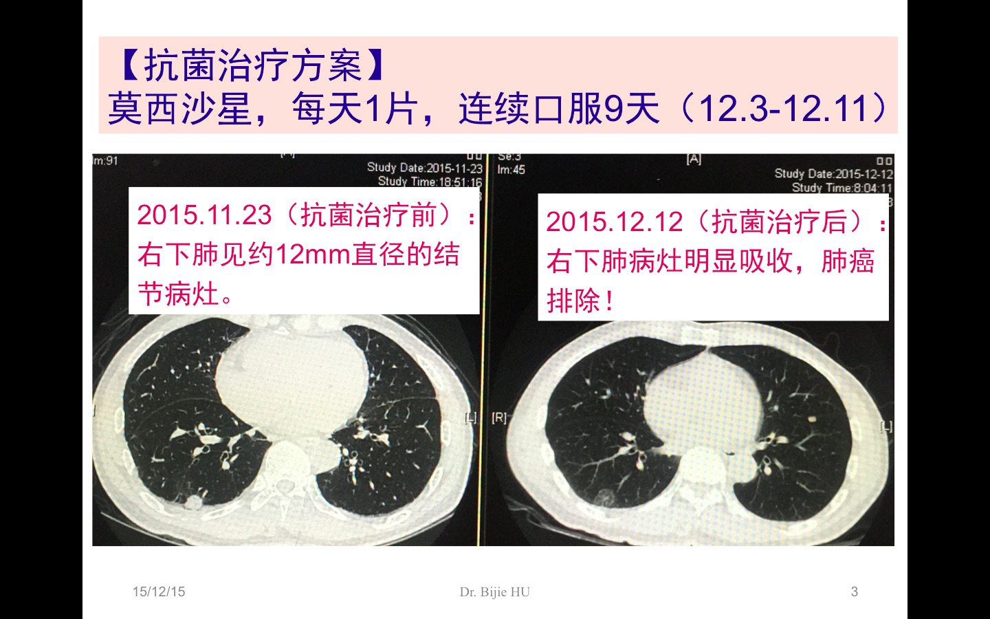 肺小结节-感染 vs 肿瘤-3.jpg
