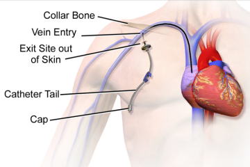 PICC、CVC、PORT、MC、UVC的置管区别与图解