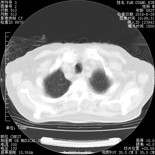 肺窗 (2).JPG