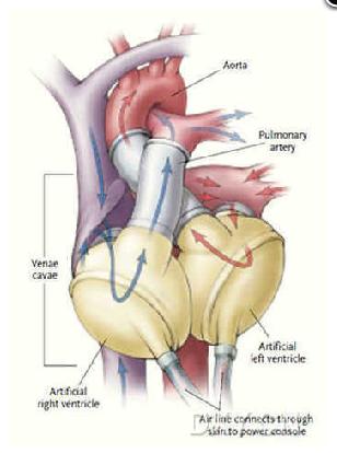 人工心脏.jpg