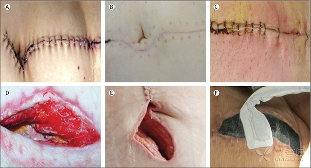 (A) 干净的伤口；(B) 愈合后伤疤（术后30天）；(C) 浅表手术部位感染及伤口红肿（术后七天）；(D) 手术部位 ...