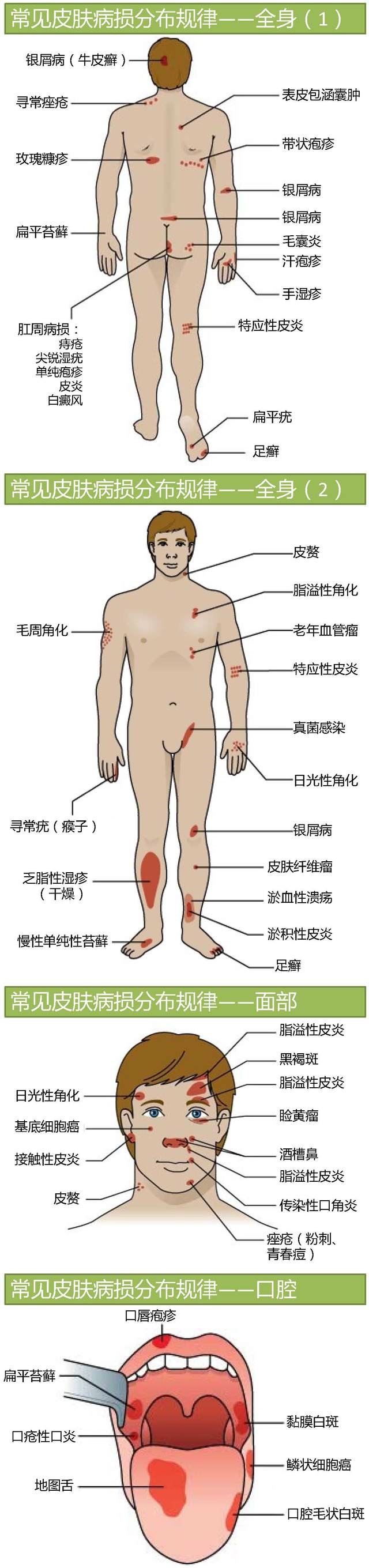 各种皮肤病好发部位.jpg