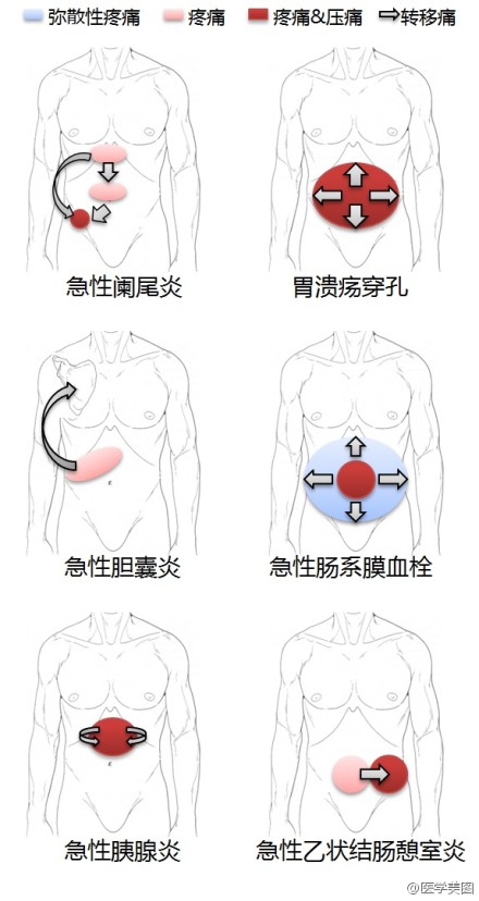 各种急腹症疼痛特点.jpg