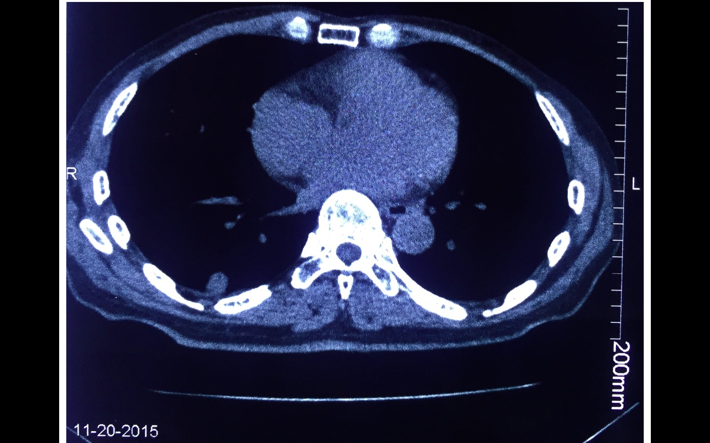 肺小结节-感染 vs 肿瘤-2.jpg