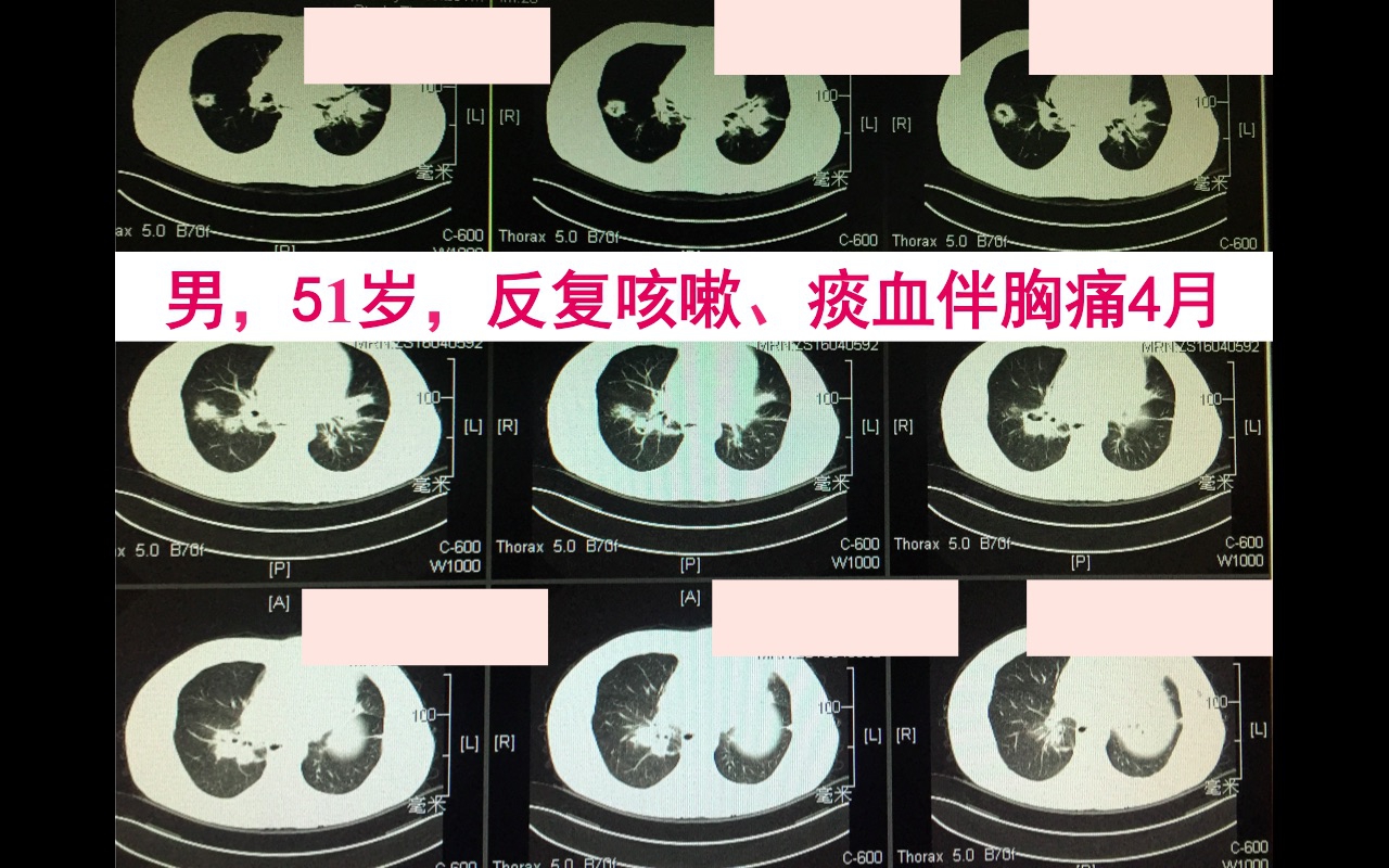 男，51岁，反复咳嗽、痰血伴胸痛4月.jpg