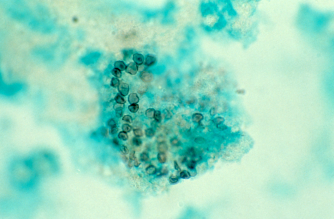 肺孢子3.png