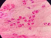 少见菌图文报告，您听我解释之—脑膜炎奈瑟菌