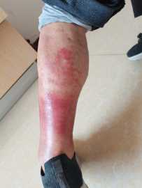 这是什么感染？什么病？