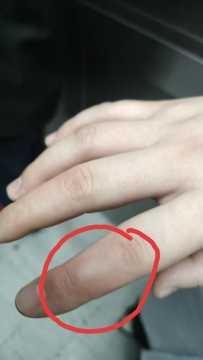 医务人员烧伤需要报职业暴露吗？