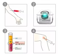 骨科PRP治疗如何规范感控工作？