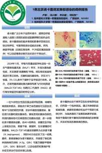 《1例北京诺卡菌诱发肺部感染的病例报告》